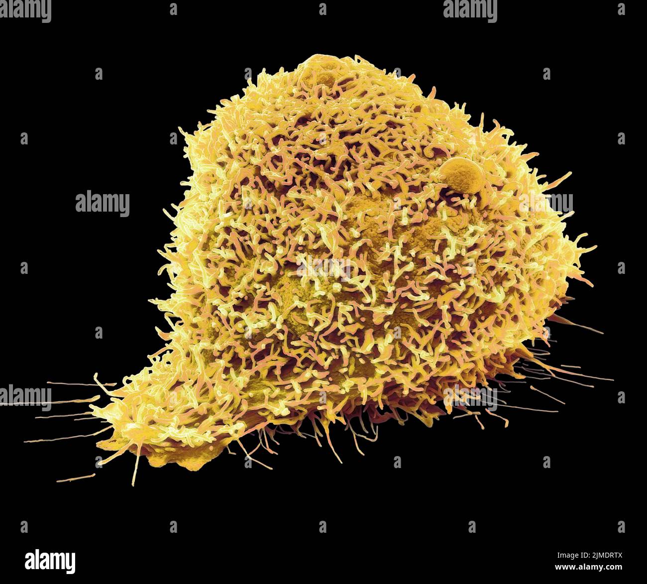 Cellule tumorali renali, SEM Foto Stock