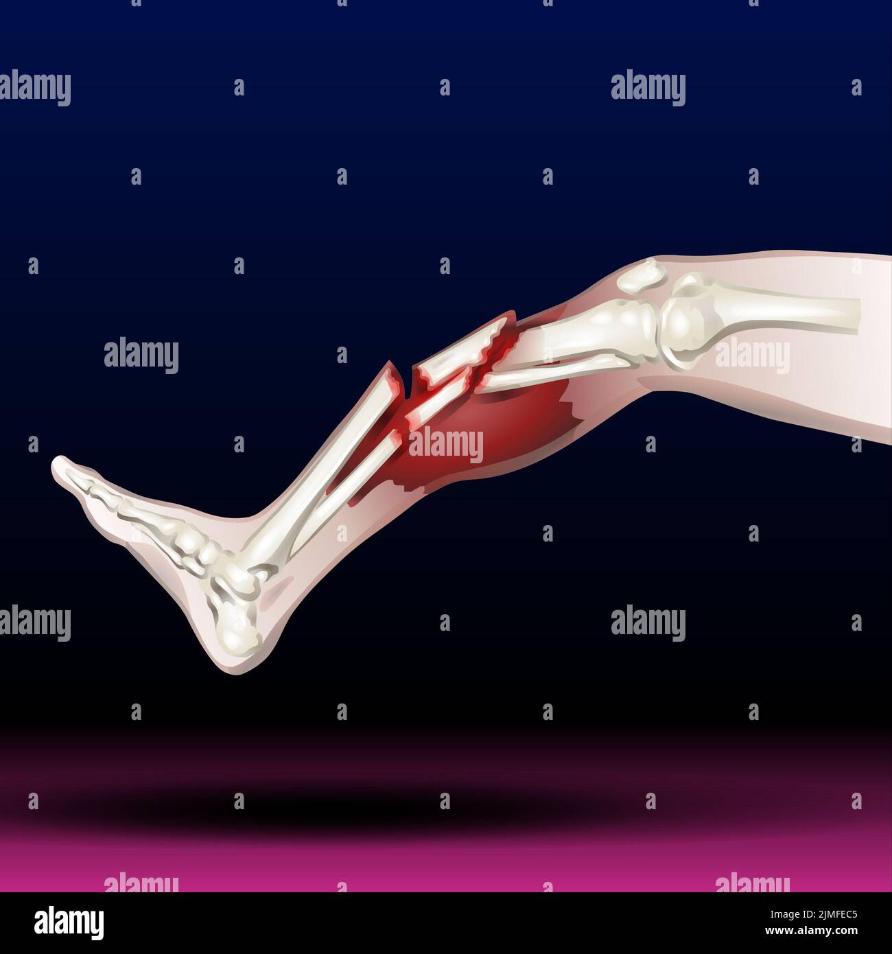 Frattura ossea della gamba - illustrazione Foto Stock