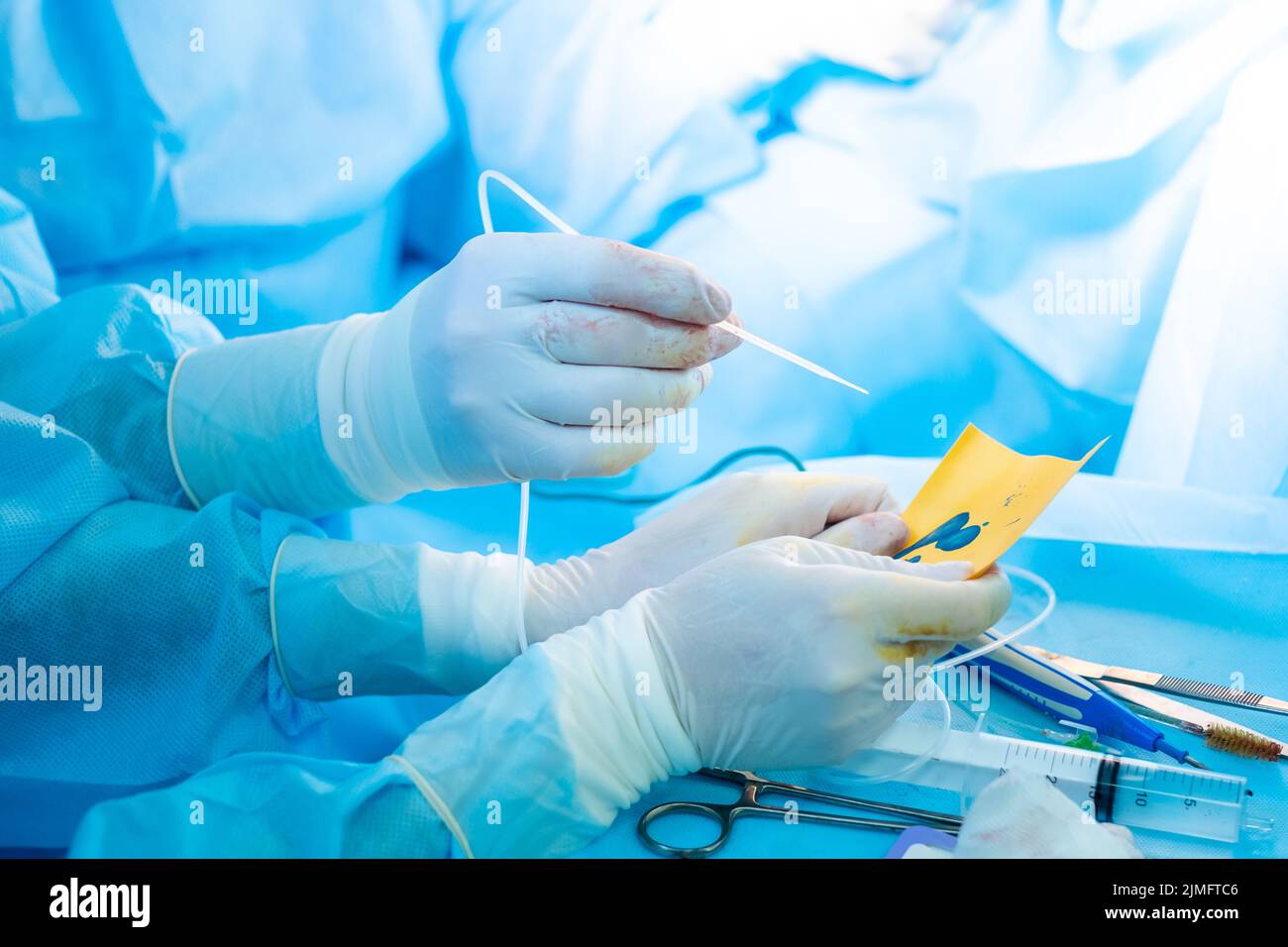 La mano del chirurgo in un guanto sterile contiene un erogatore di colla di fibrina. Foto Stock