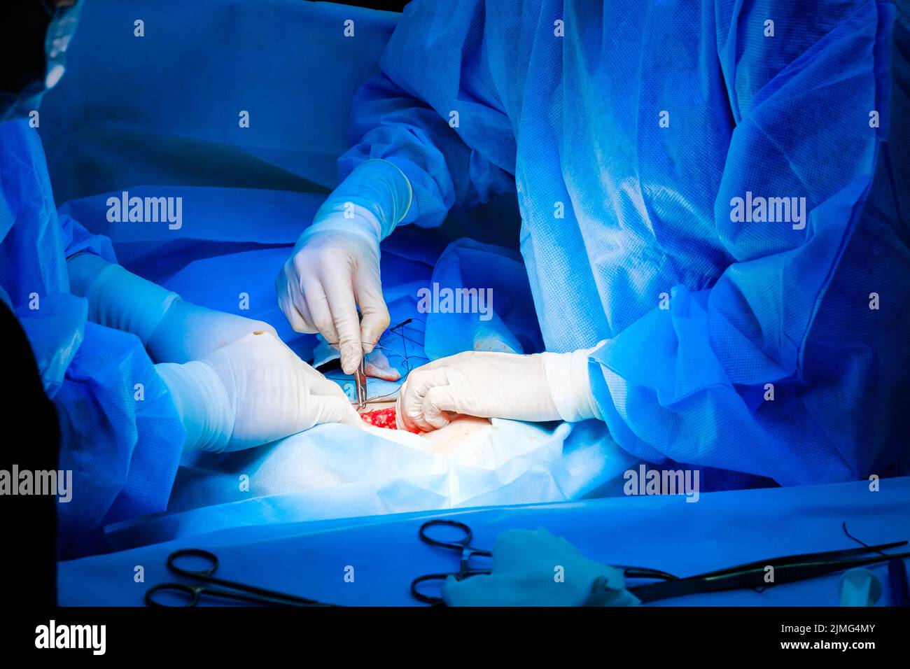 Le mani dei chirurghi in guanti bianchi sterili cuciscono la pelle del paziente Foto Stock