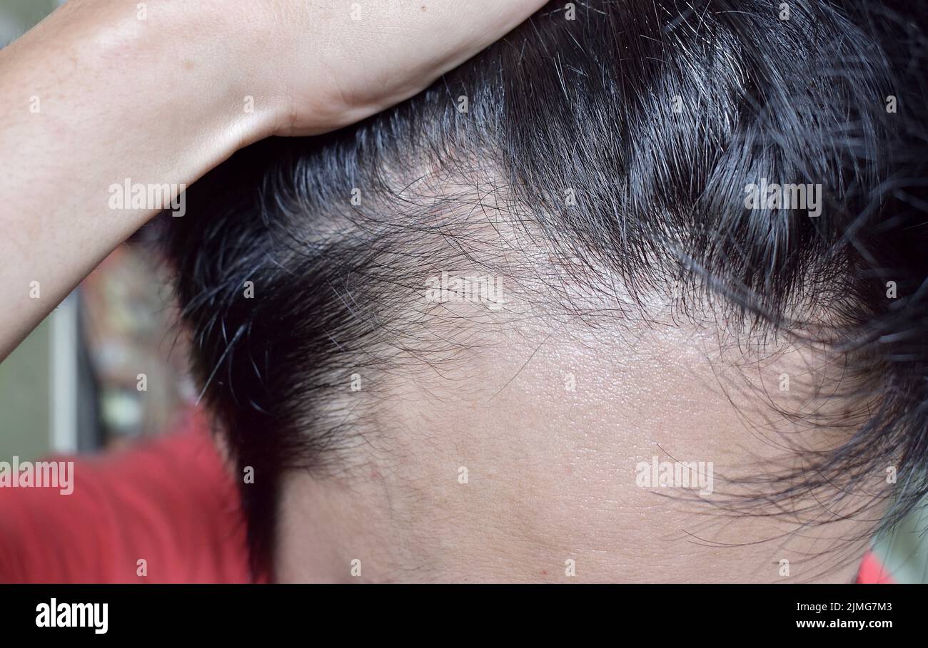 Diradamento o capelli sparsi, maschio modello perdita di capelli nel sud-est asiatico, cinese giovane uomo. Foto Stock