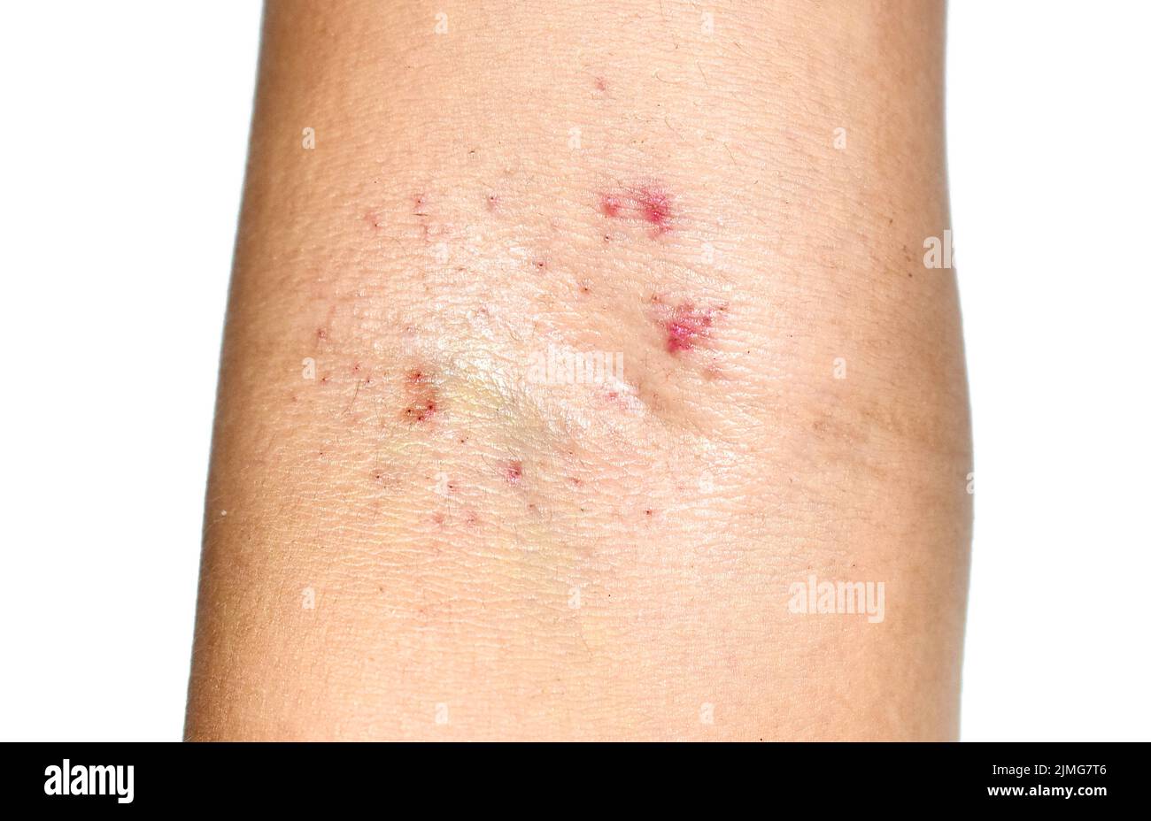 La presenza di più macchie rosse nella fossa cubitale dimostra che il test di Hess è positivo. Dengue febbre emorragica. Foto Stock