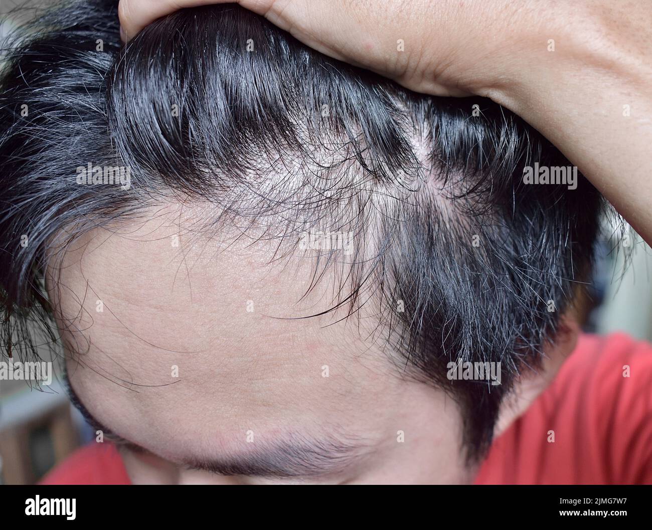 Diradamento o capelli sparsi, maschio modello perdita di capelli nel sud-est asiatico, cinese giovane uomo. Foto Stock