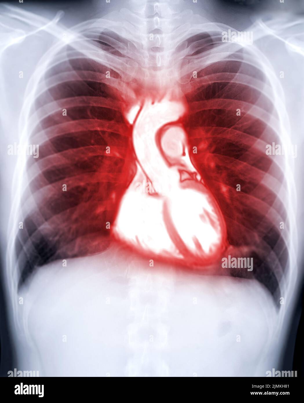 Radiografia toracica fusione di immagini rm cuore per diagnosi di malattie cardiache. Foto Stock
