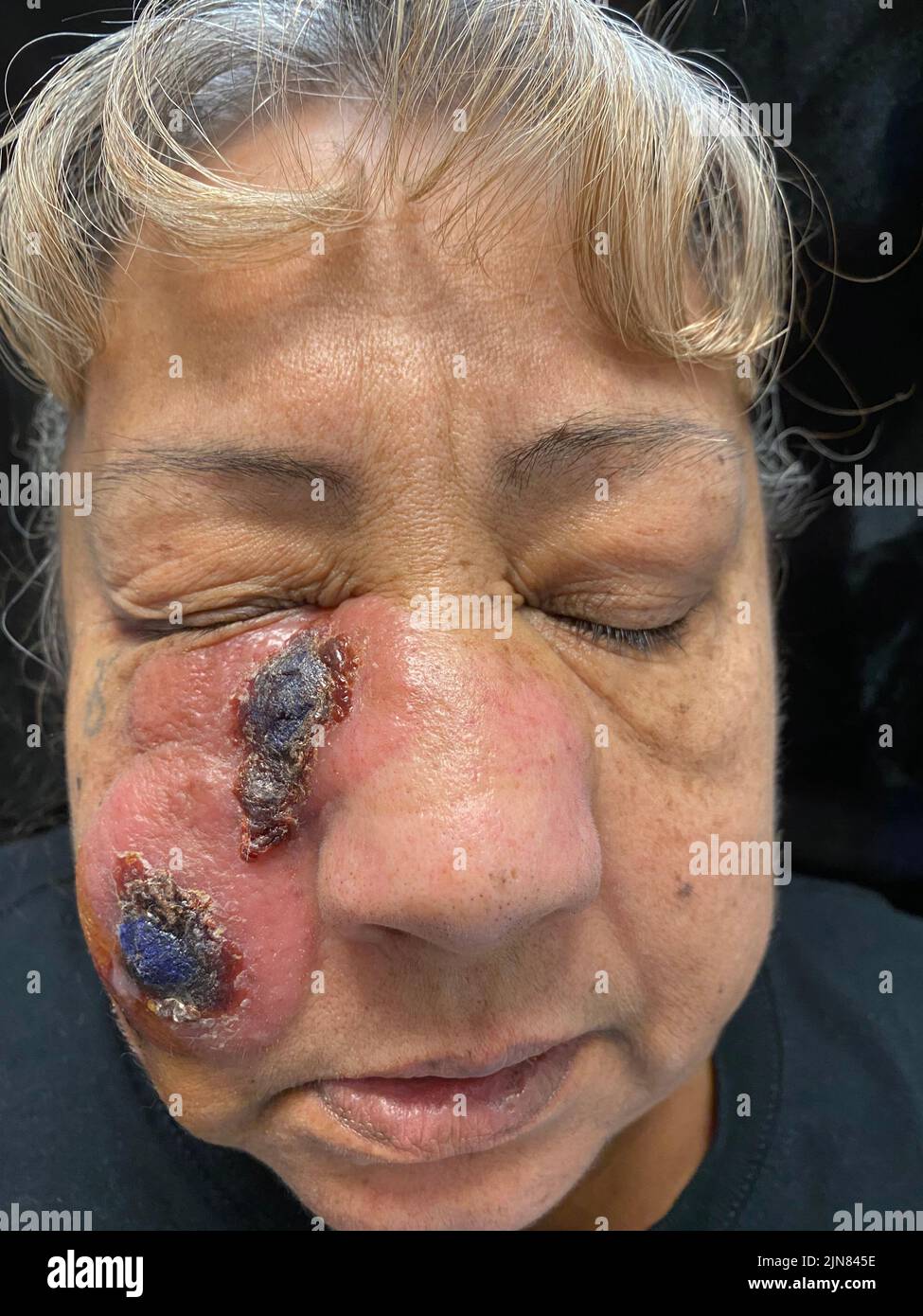Linfoma cutaneo a cellule t. Foto Stock