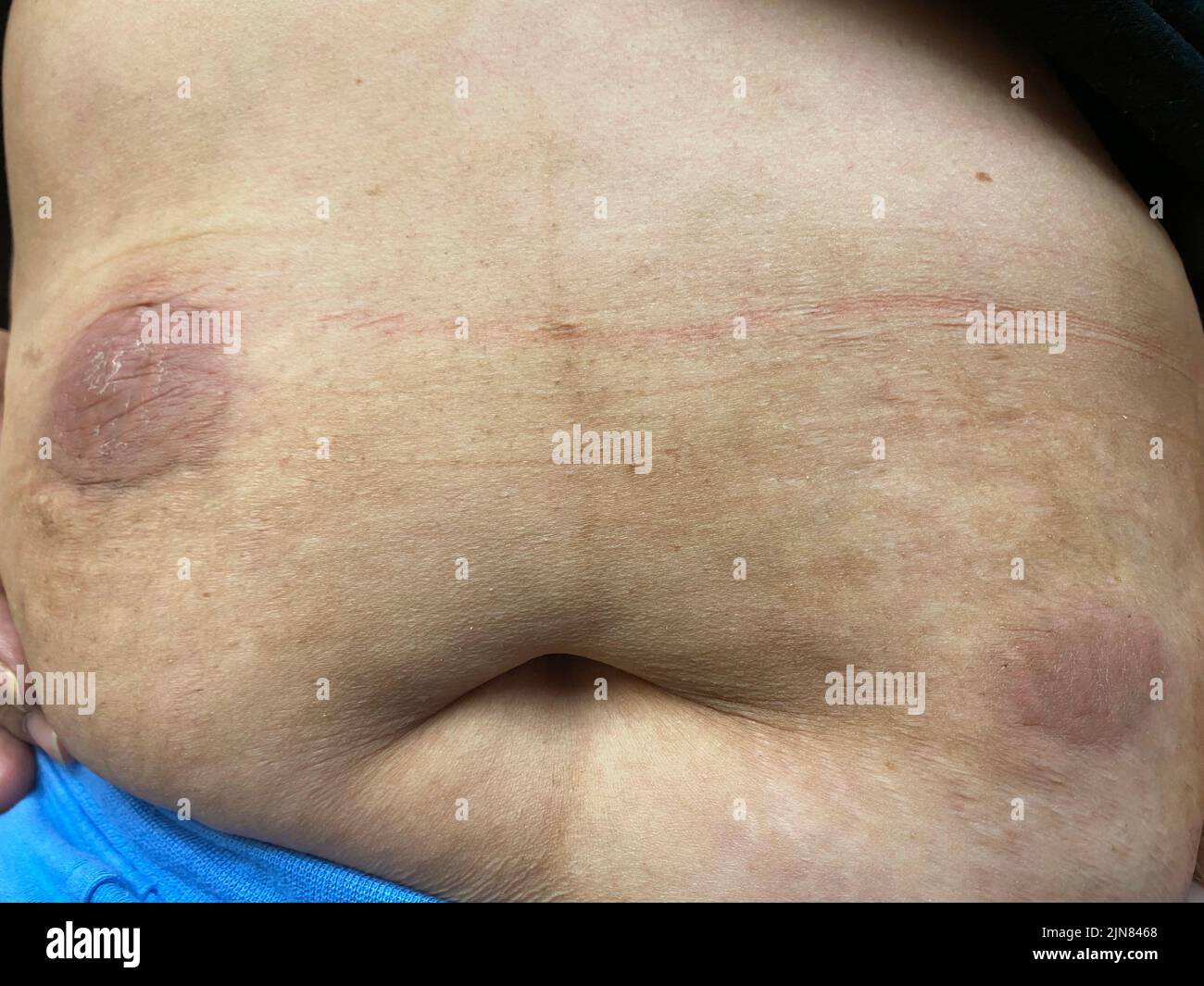 Linfoma cutaneo a cellule t. Foto Stock