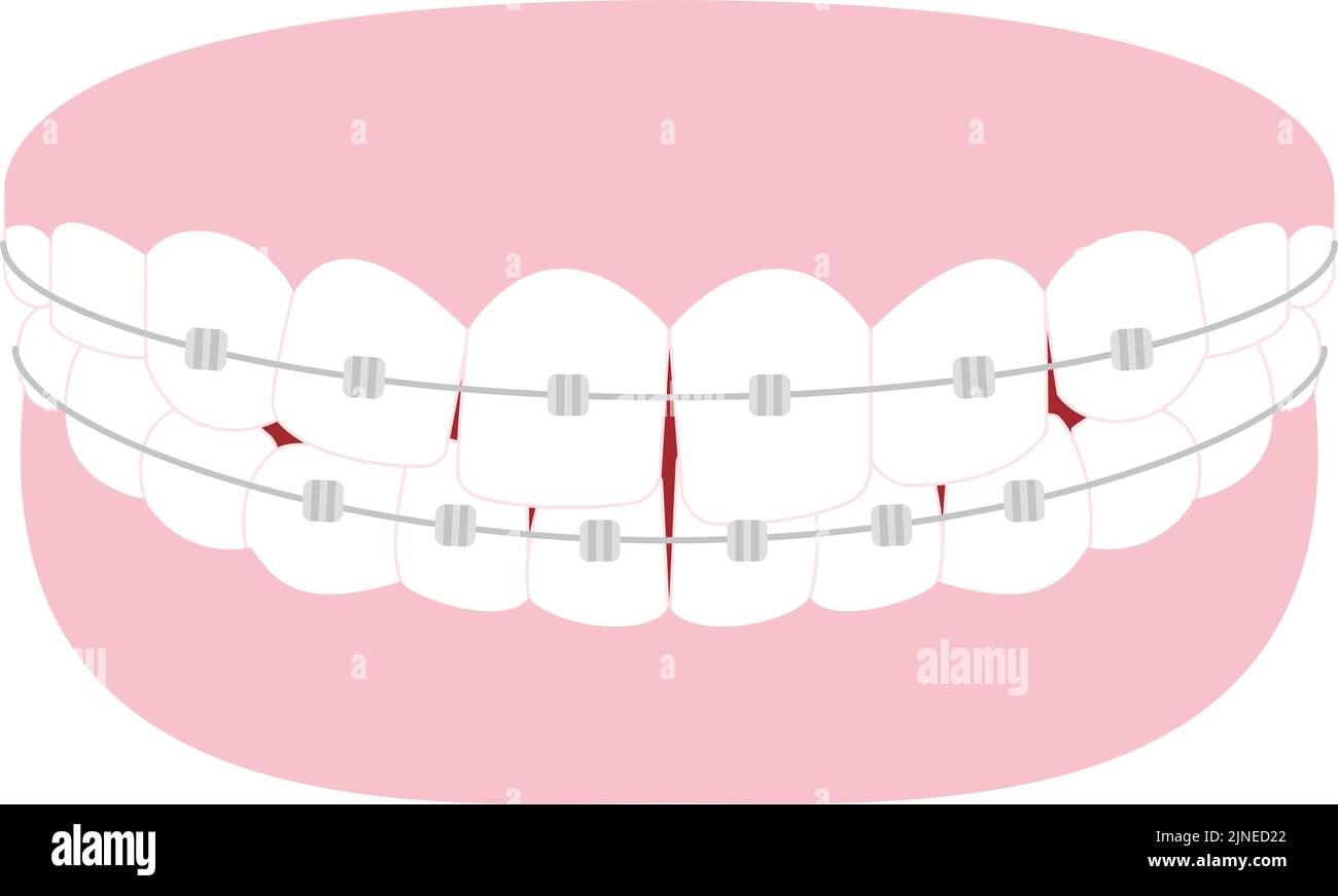 Illustrazione dell'odontoiatria estetica e dell'ortodonzia: Disposizione dei denti distorta e staffa metallica Illustrazione Vettoriale