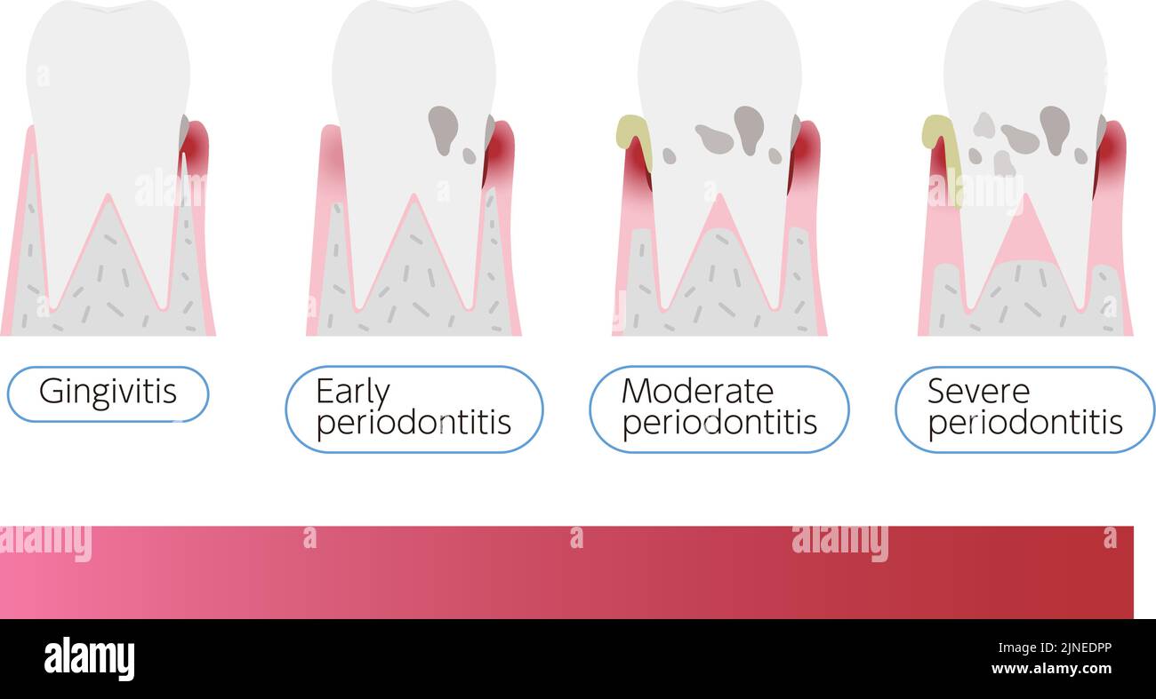 Illustrazione per fase della malattia parodontale: Ordine di avanzamento Illustrazione Vettoriale