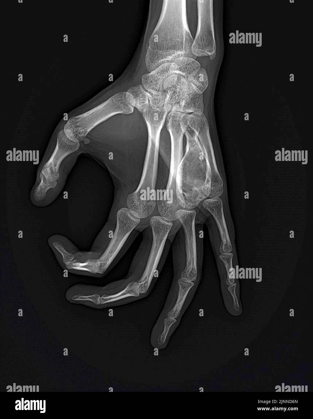 Cisti ossee aneurismiche della mano, raggi X. Foto Stock