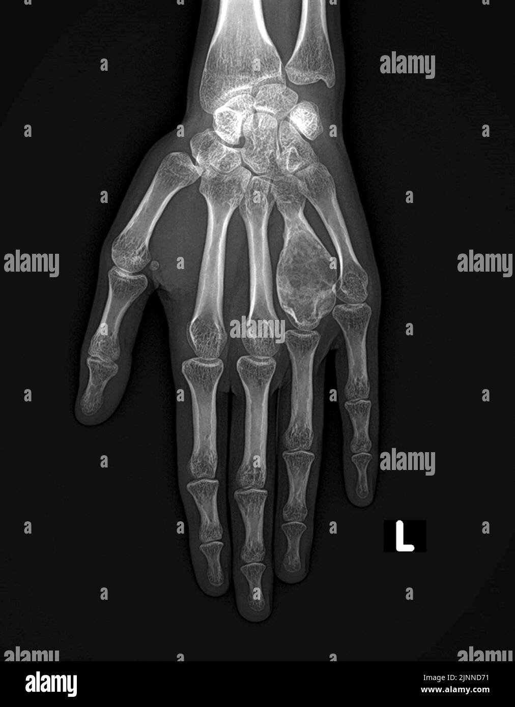 Cisti ossea aneurismatica della mano, raggi X. Foto Stock