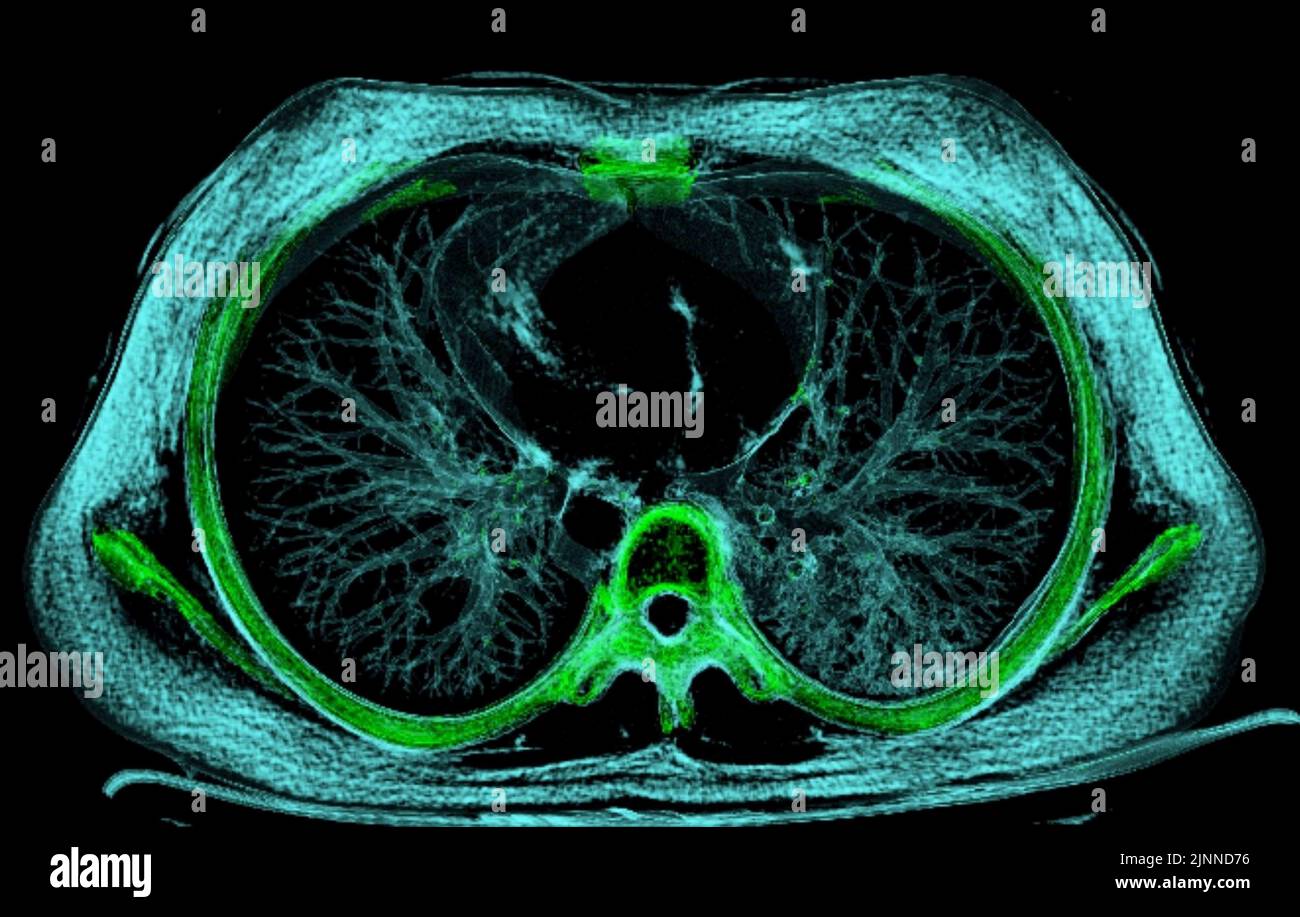 Polmone normale, scansione TC Foto Stock