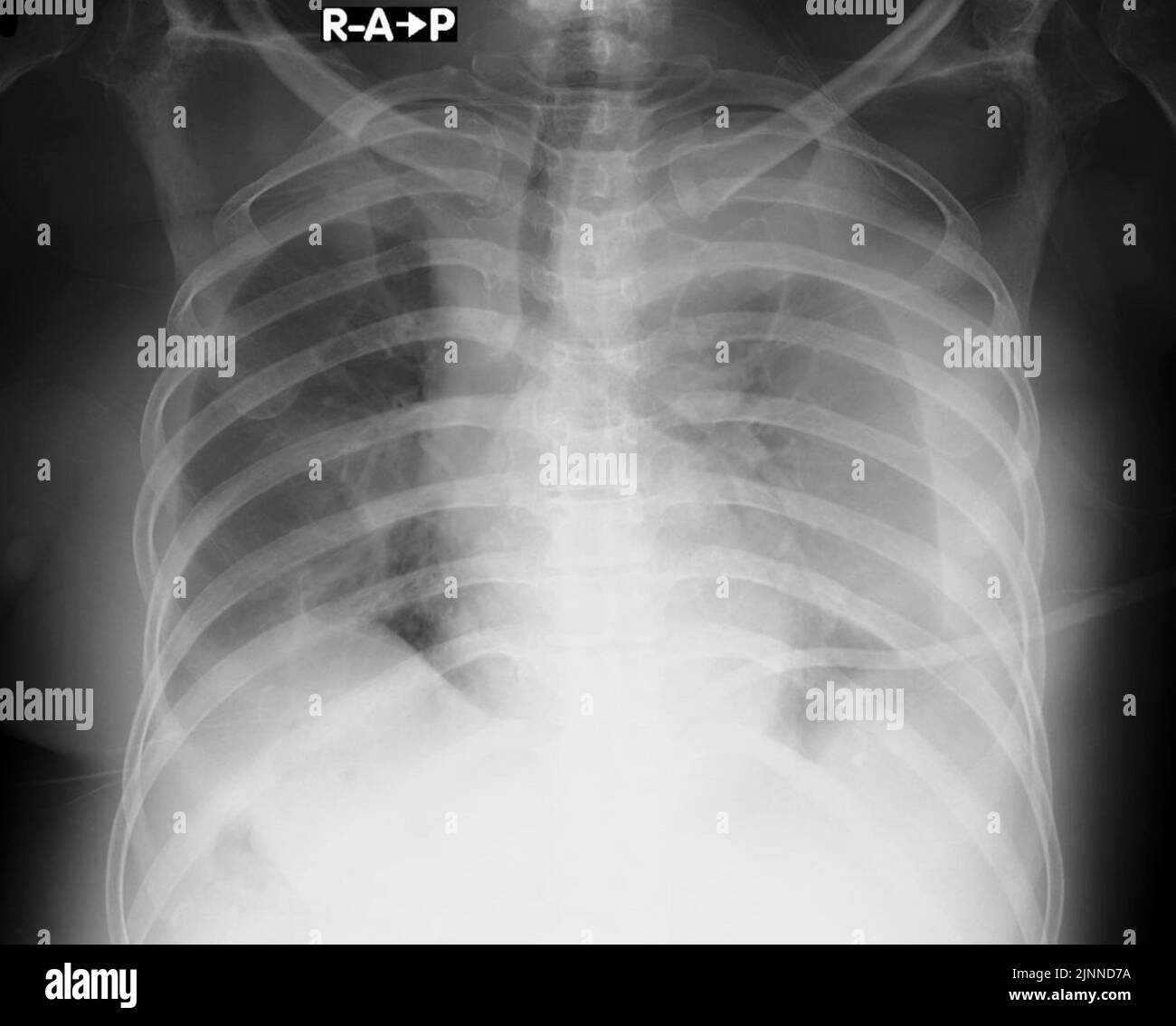 Versamento pleurico, raggi X. Foto Stock