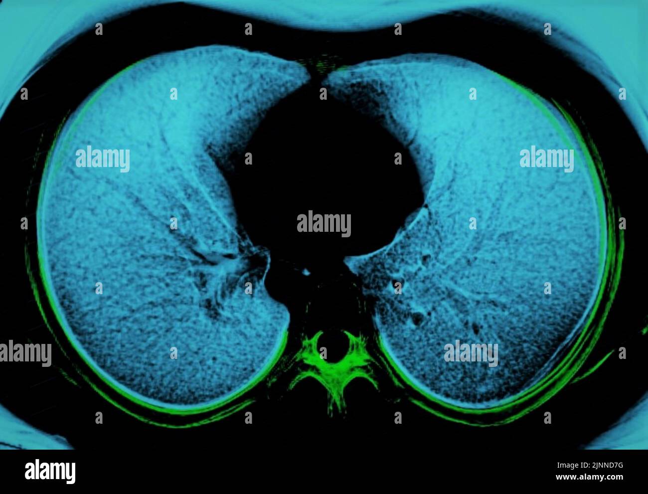 Polmone normale, scansione TC Foto Stock