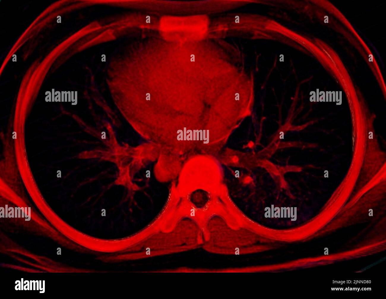 Polmone normale, scansione TC Foto Stock