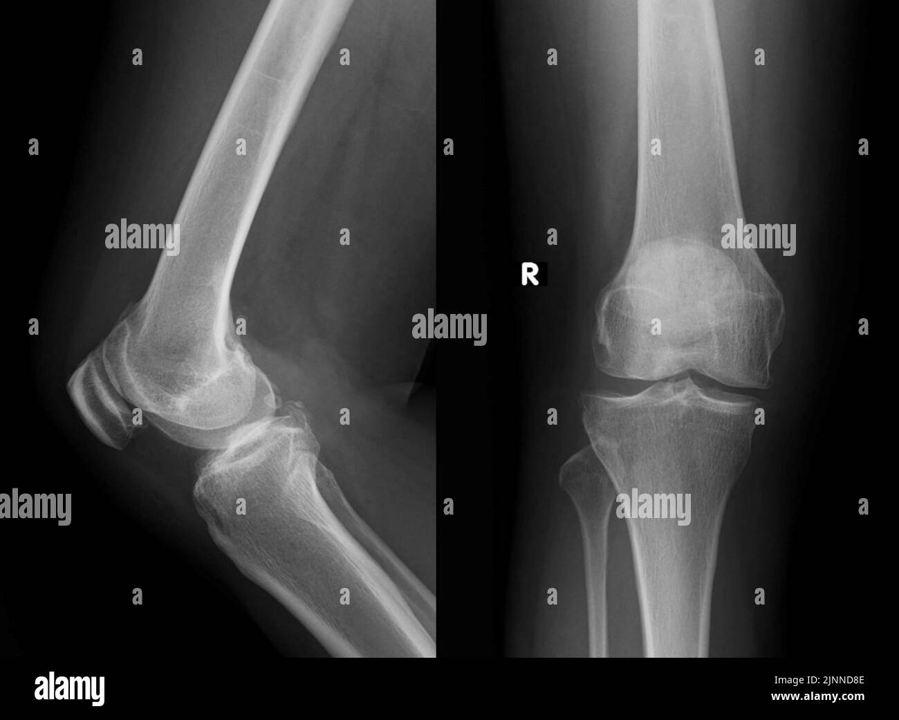 Osteoartrite del ginocchio, raggi X. Foto Stock