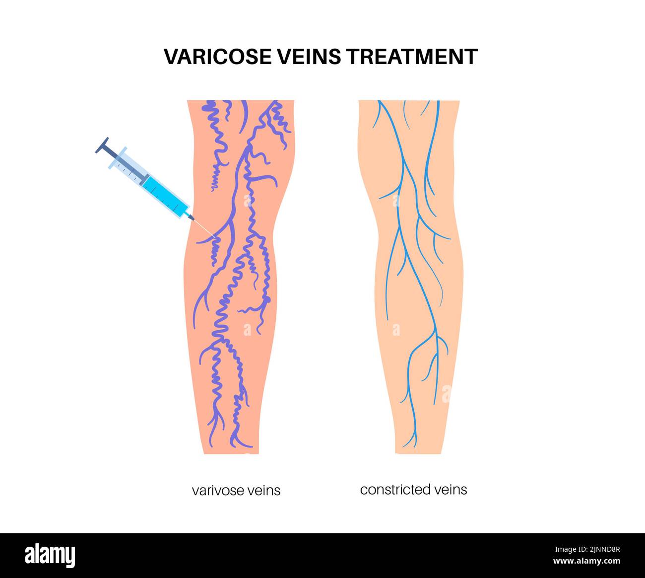Trattamento venoso varicoso, illustrazione Foto Stock