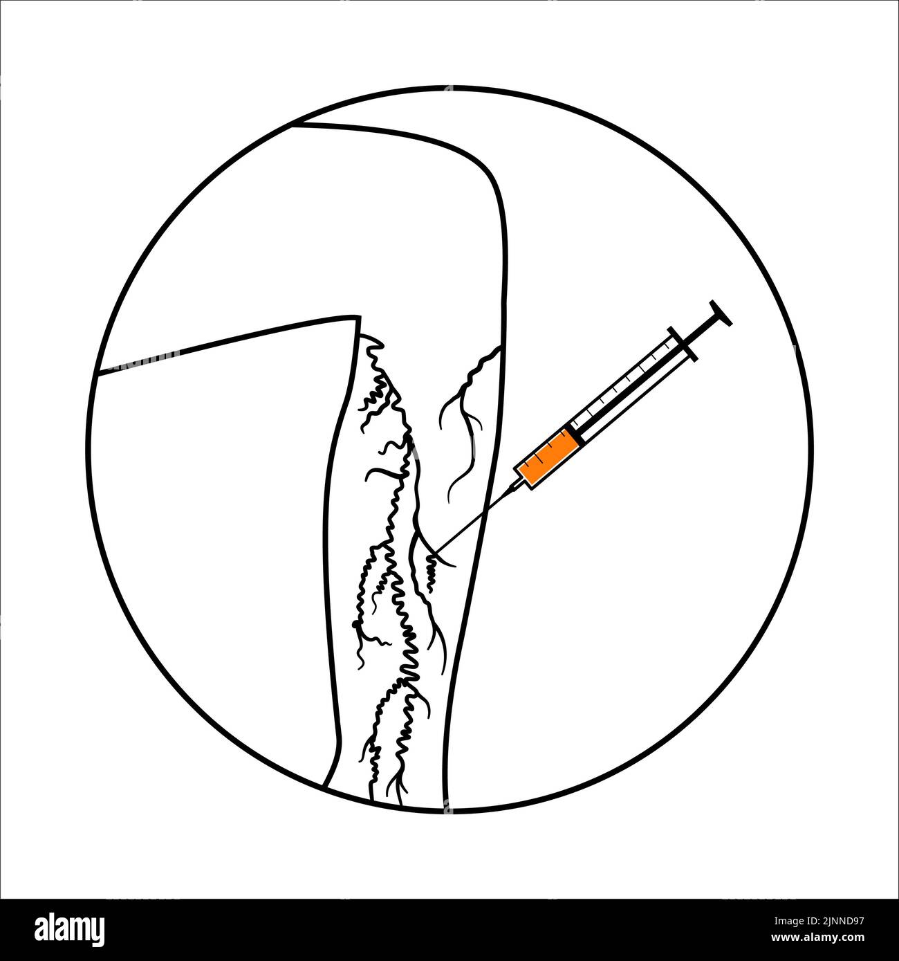 Trattamento venoso varicoso, illustrazione Foto Stock