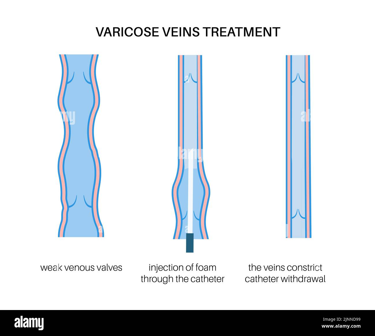Trattamento venoso varicoso, illustrazione Foto Stock
