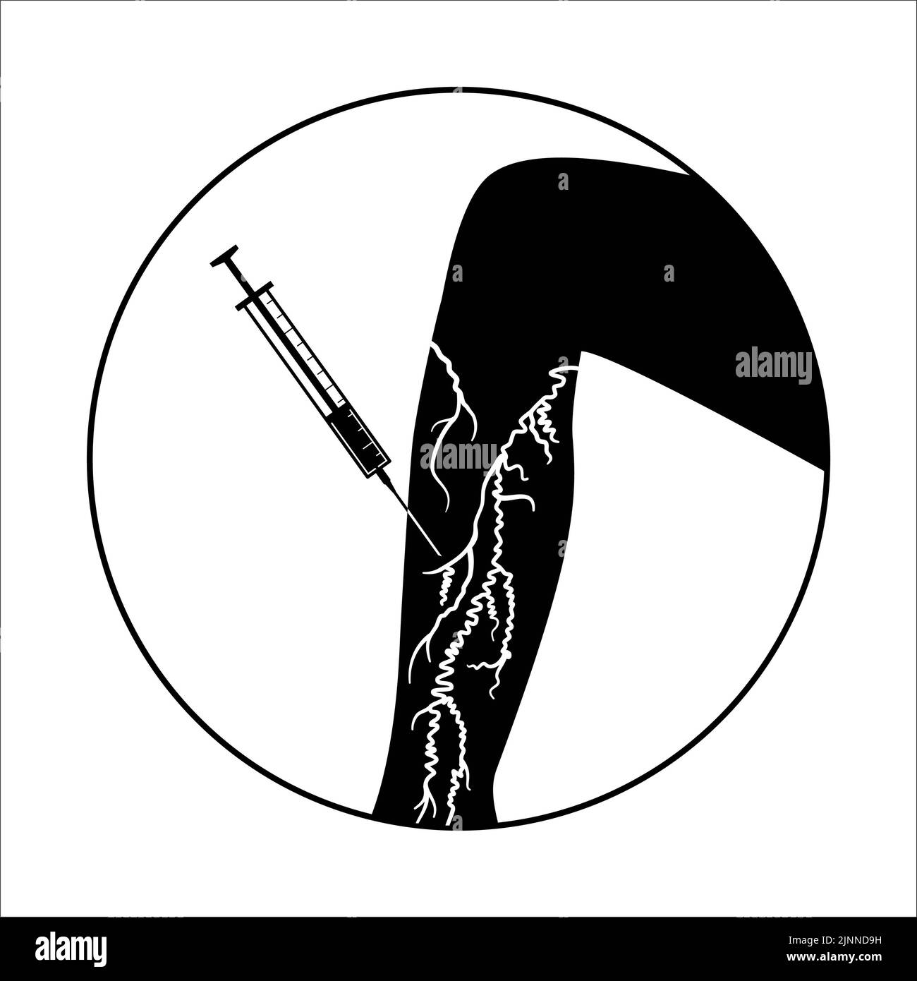 Trattamento venoso varicoso, illustrazione Foto Stock