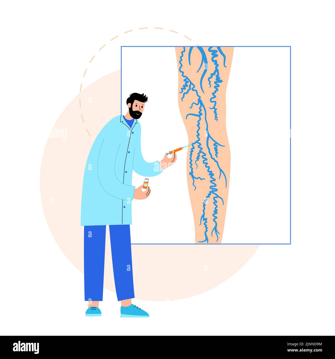 Trattamento venoso varicoso, illustrazione Foto Stock