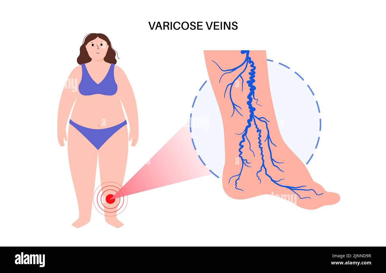 Trattamento venoso varicoso, illustrazione Foto Stock