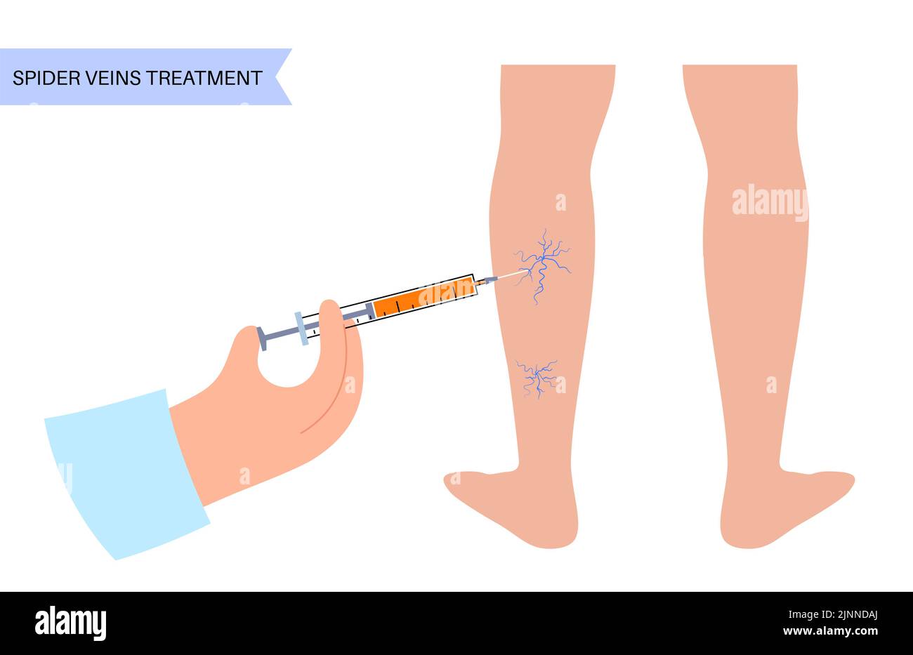 Trattamento della vena del ragno, illustrazione Foto Stock