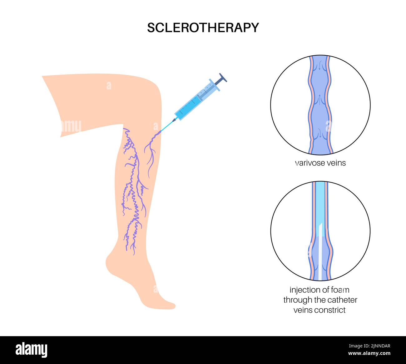 Trattamento venoso varicoso, illustrazione Foto Stock