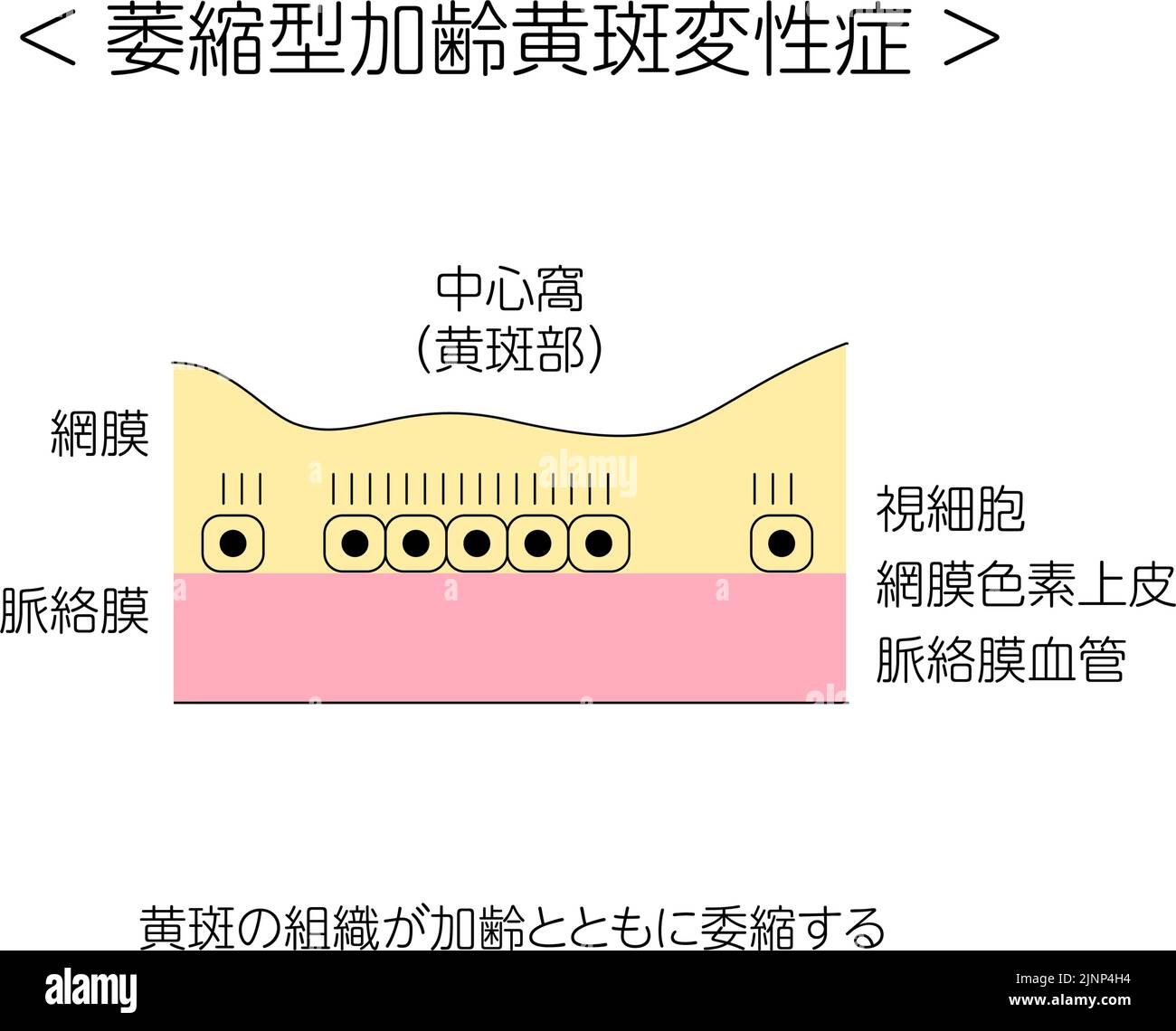 Malattia degli occhi, degenerazione maculare atrofica legata all'età illustrata - traduzione: Stato normale, degenerazione maculare atrofica legata all'età, atrofia di Illustrazione Vettoriale