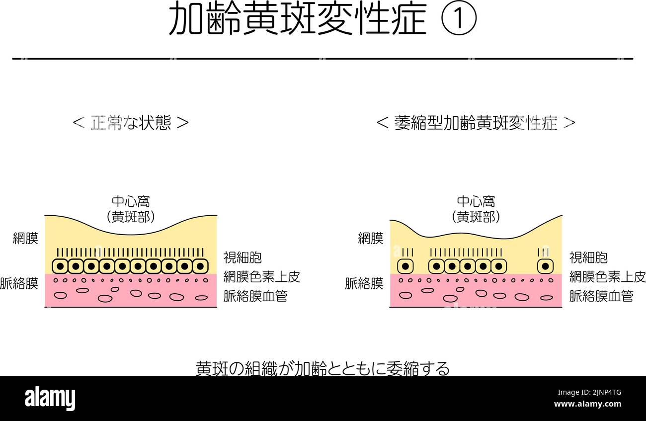 Malattia degli occhi, degenerazione maculare atrofica legata all'età illustrata - traduzione: Stato normale, degenerazione maculare atrofica legata all'età, atrofia di Illustrazione Vettoriale