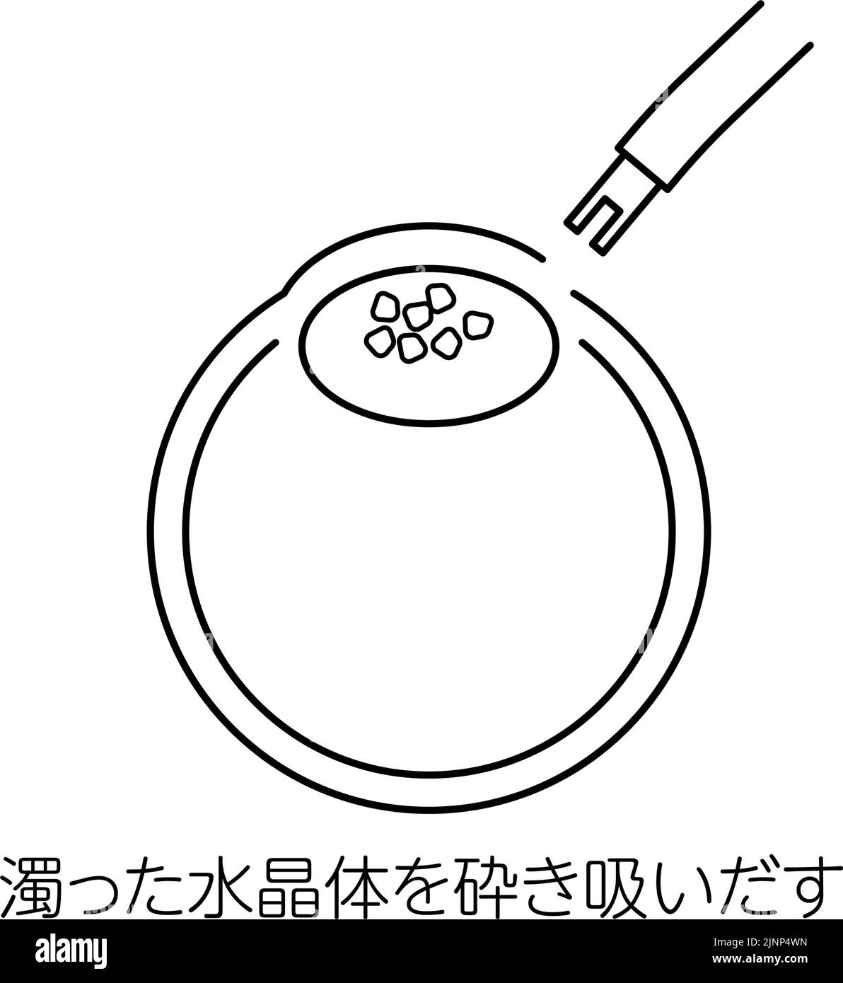 Processo di chirurgia della cataratta, Illustrazione (disegno di linea), succhiare fuori la lente nuvolosa - traduzione: Succhiare fuori la lente nuvolosa Illustrazione Vettoriale