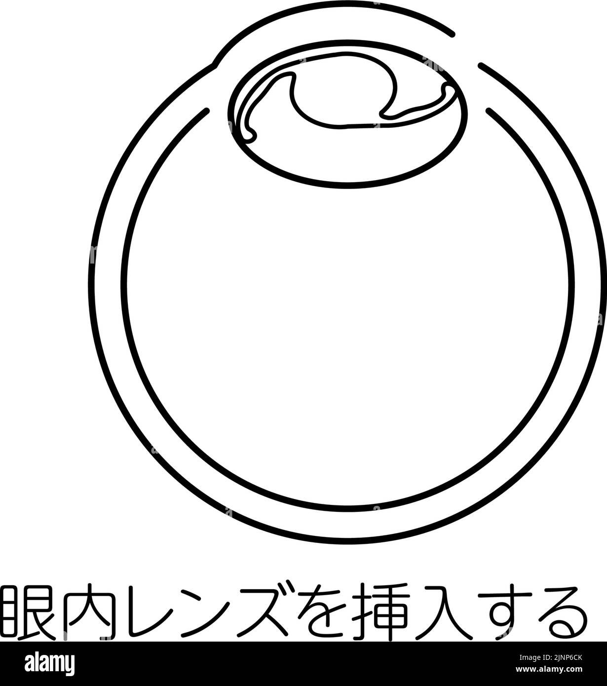 Flusso di chirurgia della cataratta, Illustrazione (disegno lineare), inserimento di una lente intraoculare - traduzione: Inserimento di una lente intraoculare Illustrazione Vettoriale