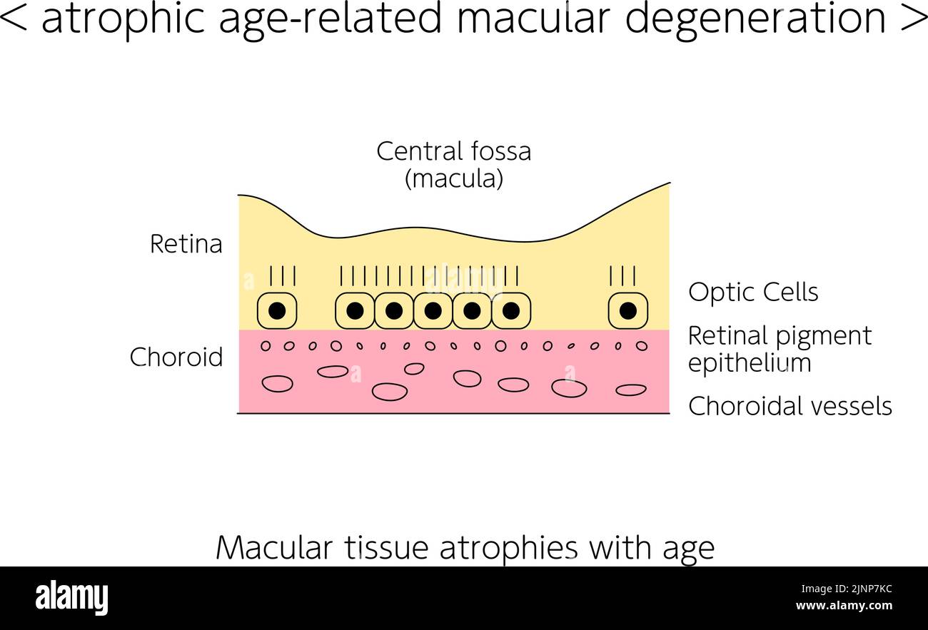 La malattia dell'occhio, degenerazione maculare atrofica legata all'età illustrata Illustrazione Vettoriale
