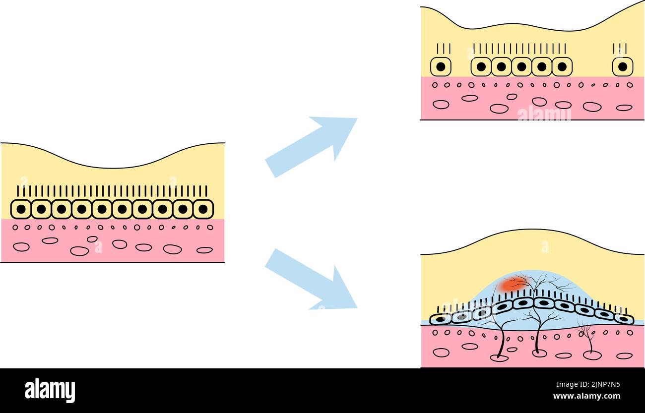 Illustrazione di malattie oculari, degenerazione maculare atrofica correlata all'età e degenerazione maculare essudativa correlata all'età Illustrazione Vettoriale