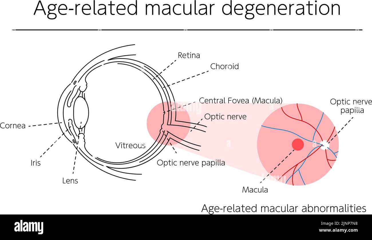 Illustrazione della malattia degli occhi, degenerazione maculare legata all'età Illustrazione Vettoriale