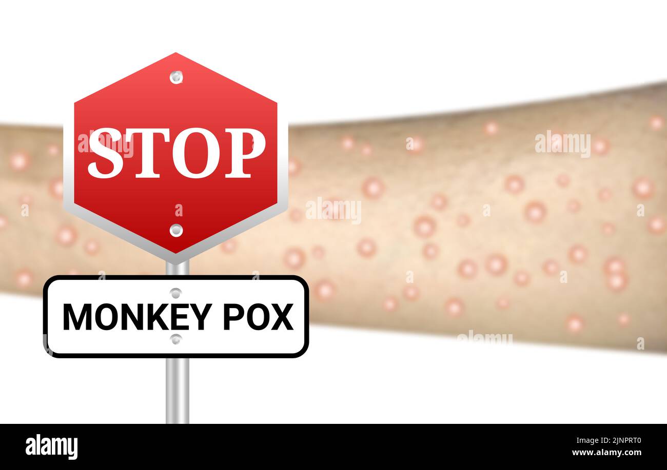 Stop scimmia pox sospiro bordo su Blur infetta mano. Mantenere la cura e regolare controllo medico concetto. Foto Stock