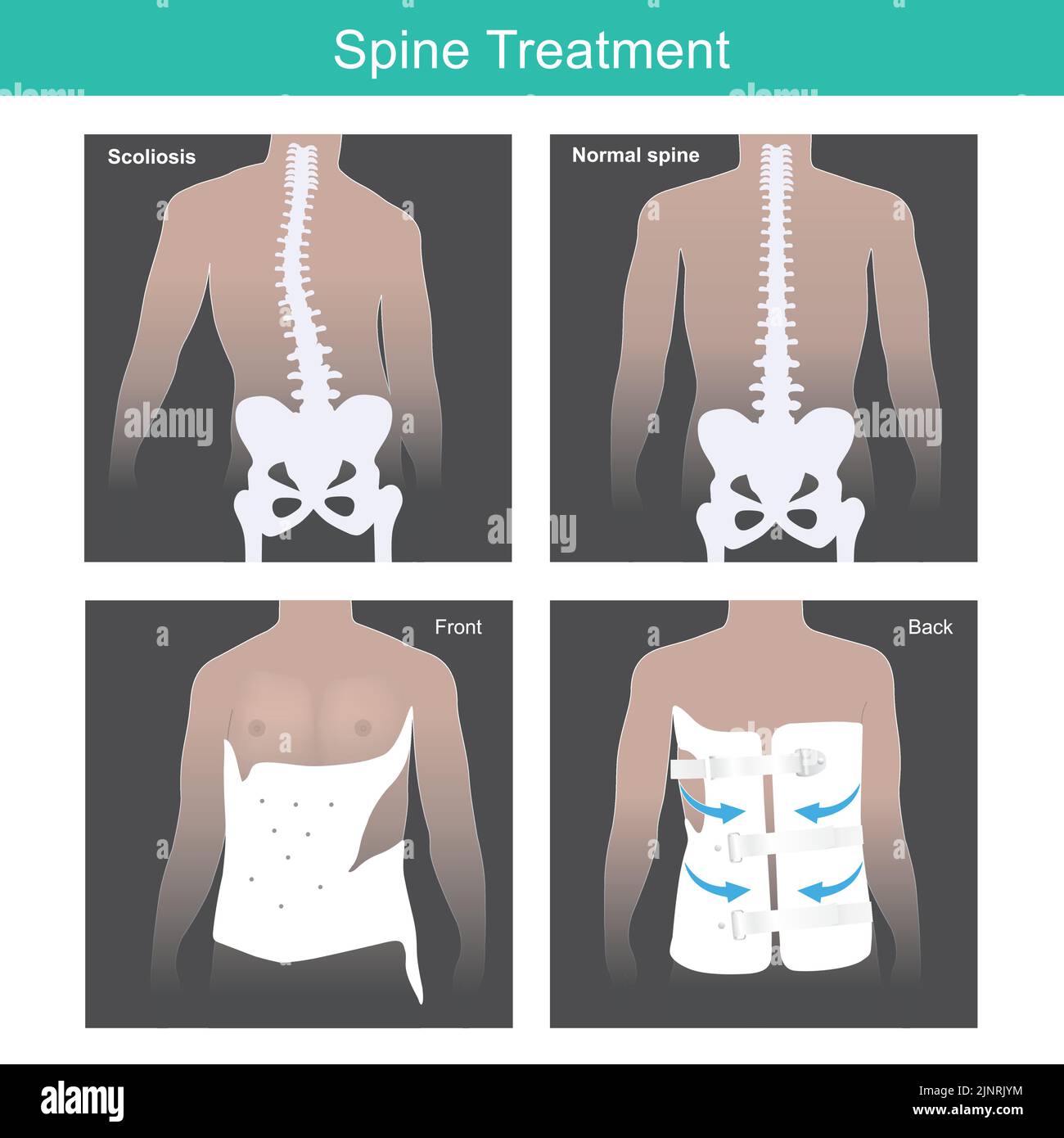 Trattamento della colonna vertebrale. Ha spina dorsale anormale e dopo il trattamento strumento di uso medico. Illustrazione del corpo anatomico. Illustrazione Vettoriale