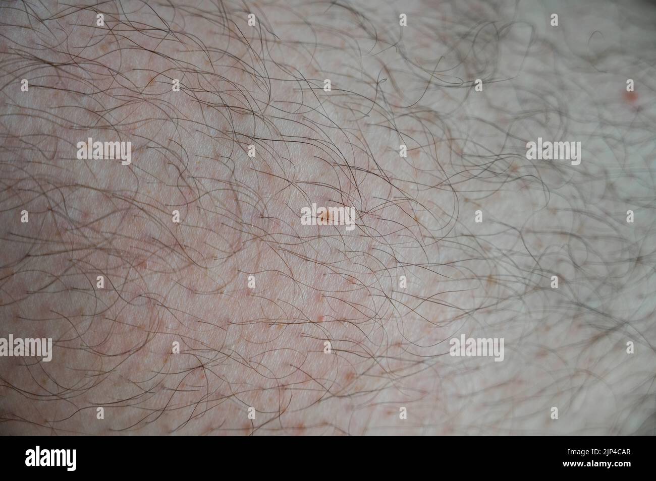 Un singolo reckle isolato su una gamba coperta di capelli Foto Stock