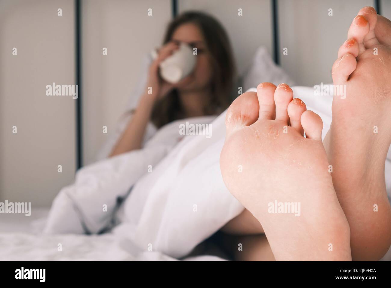 Corni e micosi. Primo piano dei piedi delle donne con calli su ogni dito. Cracking della pelle sulle gambe, infiammazione e arrossamento. Problemi della pelle Foto Stock