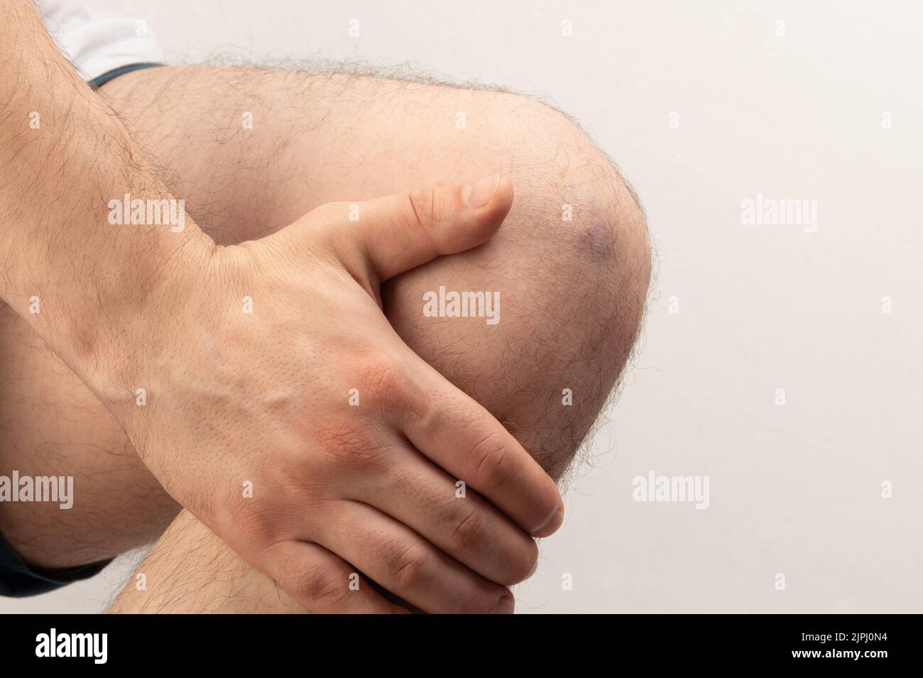 Tema del ginocchio ferito. Lividi viola dopo il colpo. Ferita a contatto Foto Stock