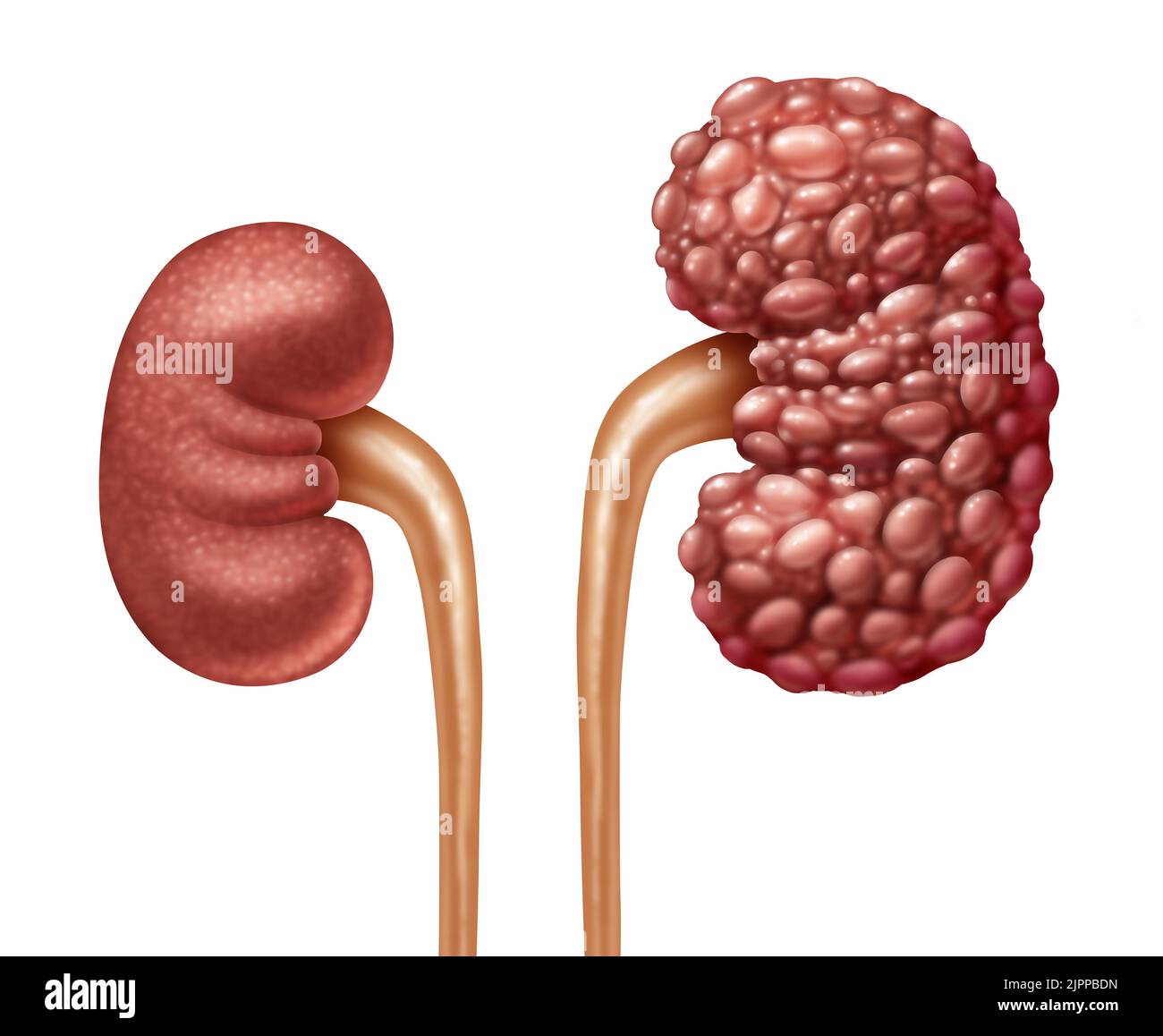 Malattia renale cronica o MRC come reni umani concetto come una malattia sana e policistica con cisti come anatomia del sistema urinario. Foto Stock