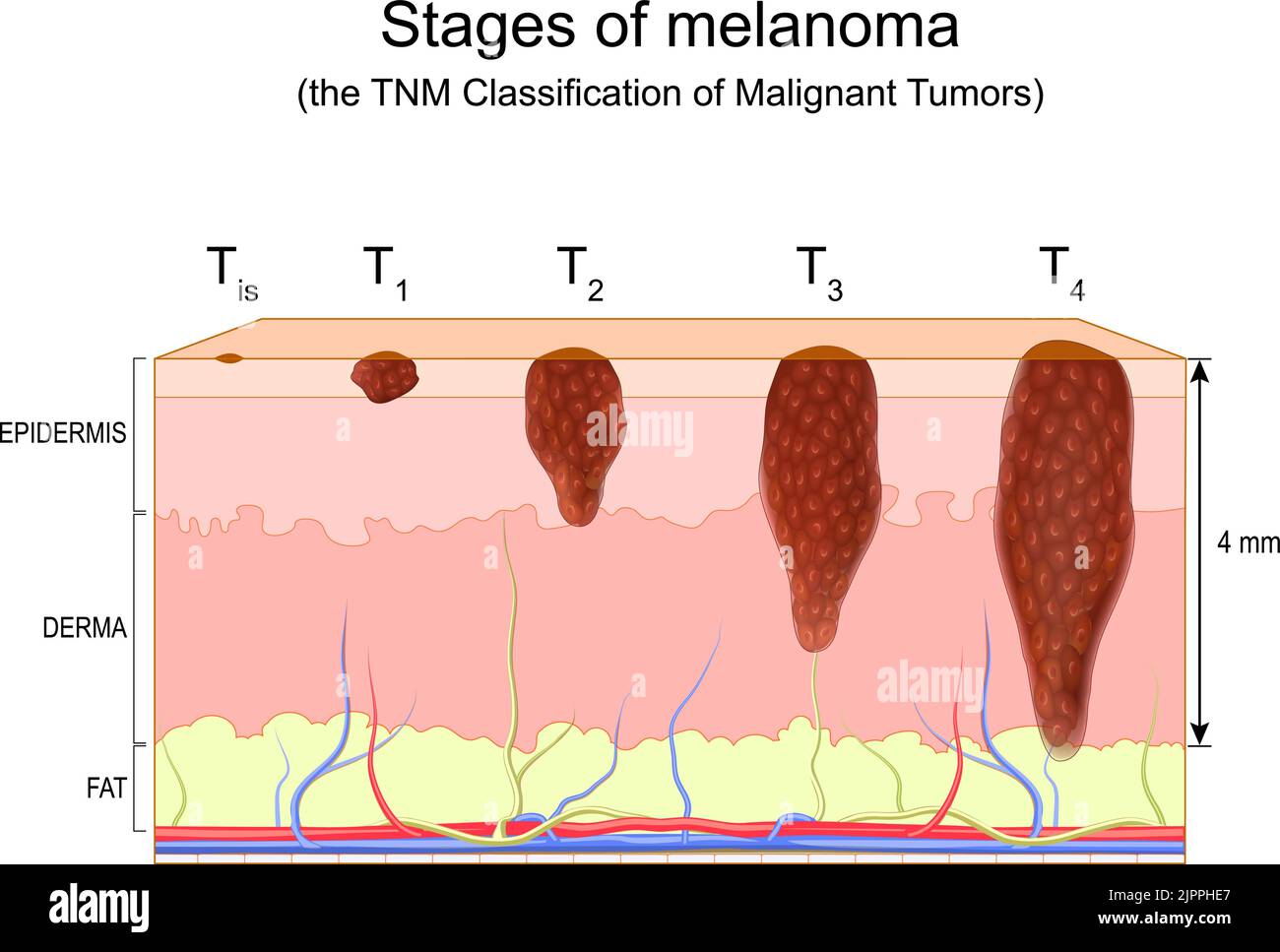 fasi di melanoma. Classificazione TNM dei tumori maligni. Metastasi del cancro della pelle. Melanoma maligno. Diagramma vettoriale Illustrazione Vettoriale