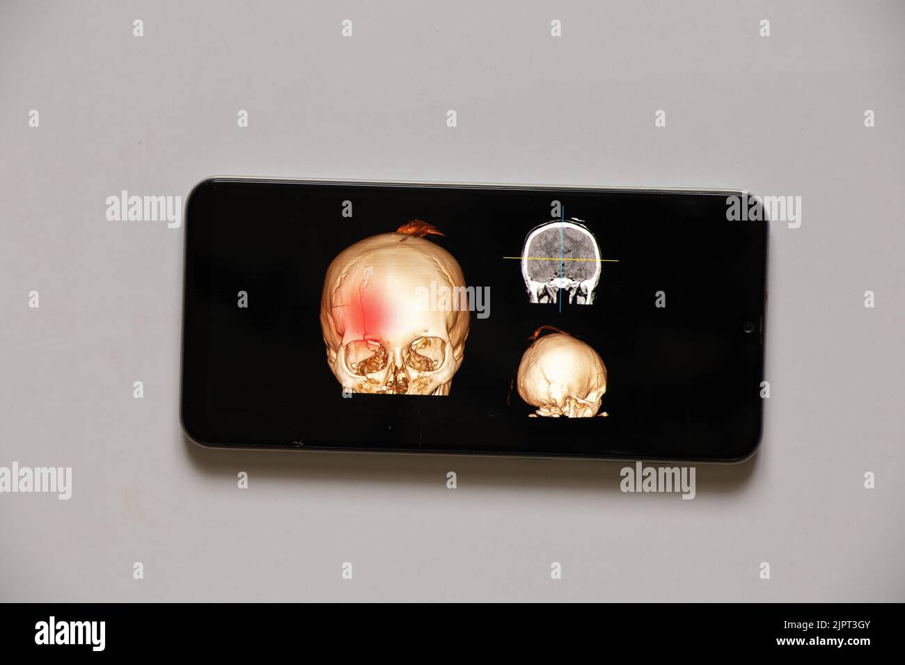 3D tomografia computerizzata del cervello con una frattura della parte frontale del cranio dopo lesione sugli schermi del telefono, applicazione mobile Foto Stock