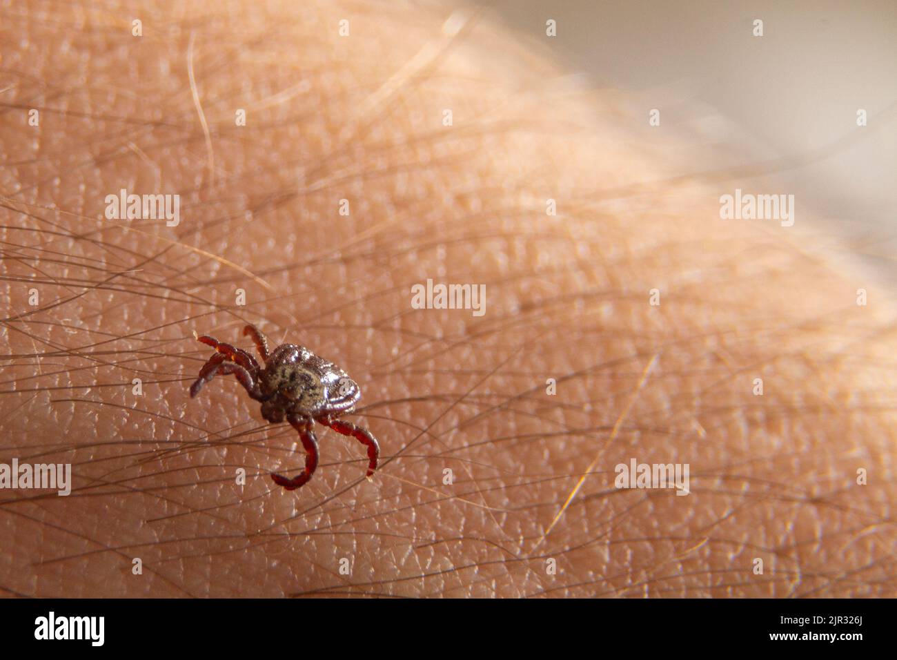 Zecca di cervo strisciante sullo sfondo della pelle pelosa umana. Insetti pericolosi infetta con malattia Foto Stock
