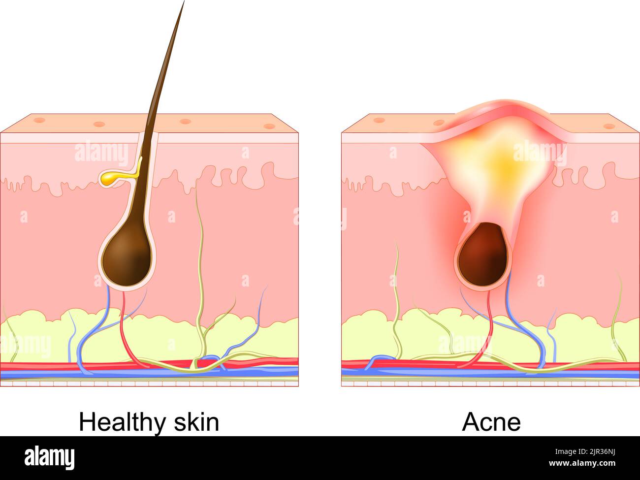 Pimple dell'acne. Follicolo normale dei capelli e poro ostruito. Differenza tra strato di pelle sana e acne. Diagramma dermatologico. Pimple dell'acne patch. Vettore Illustrazione Vettoriale