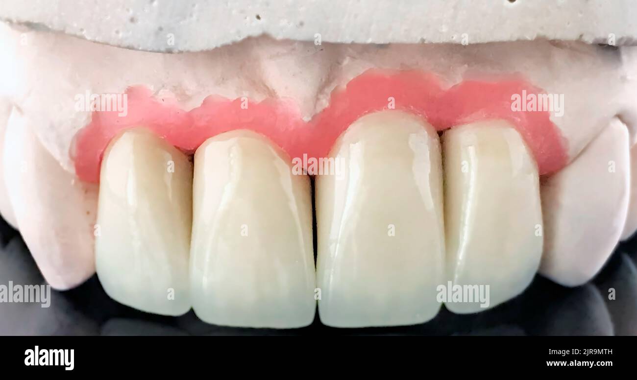 Ponte dentale in ceramica su modello in gesso. Officina di produzione di protesi dentarie. Intera dentiera di cera. Messa a fuoco selettiva. Impianto dentale. Restauro di Foto Stock