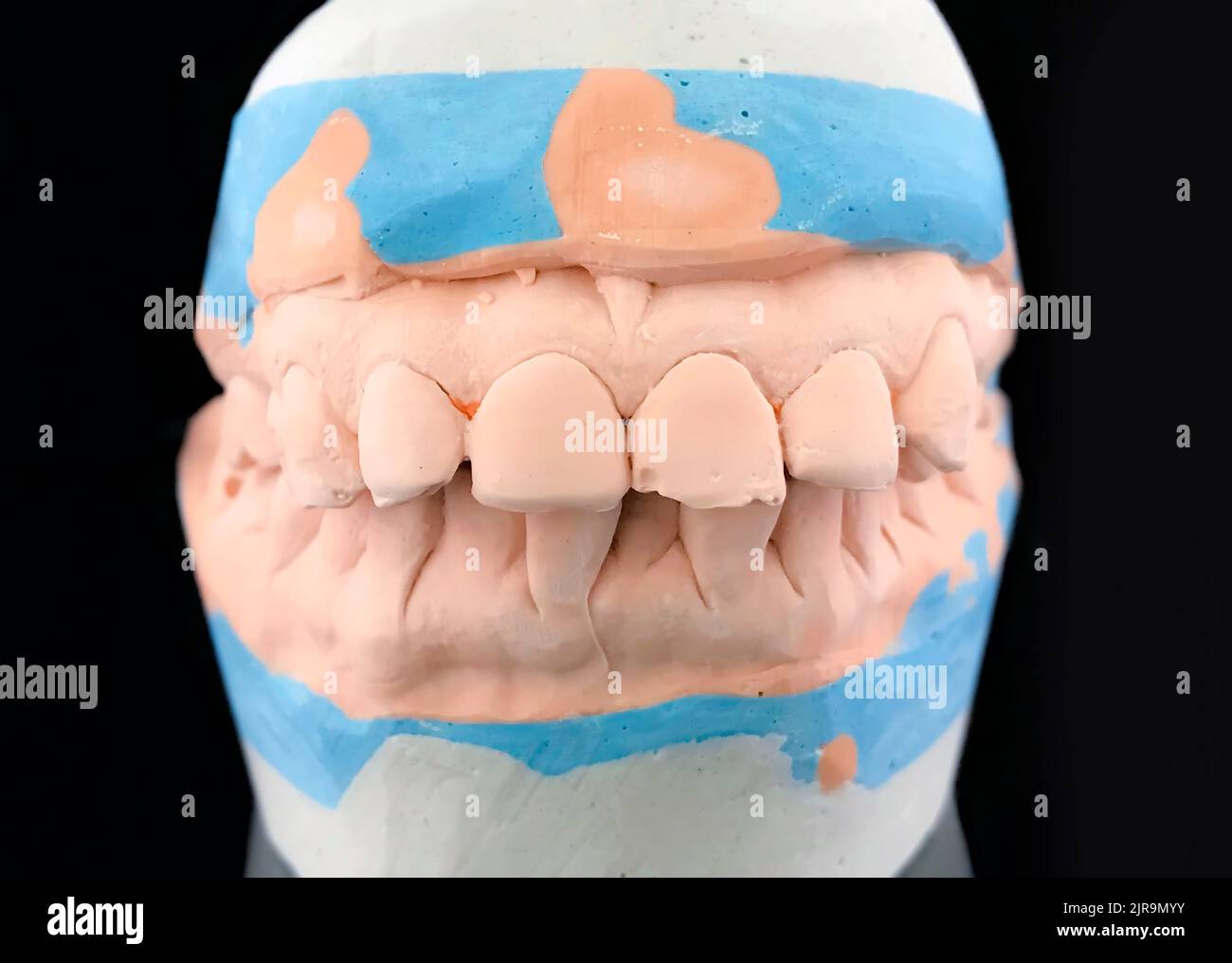 Modello di colata in gesso su sfondo nero. Chiudere la muffa di intonaco dentale del dentista. Vista frontale. Messa a fuoco selettiva. Ganascia inferiore e superiore in metallo Foto Stock