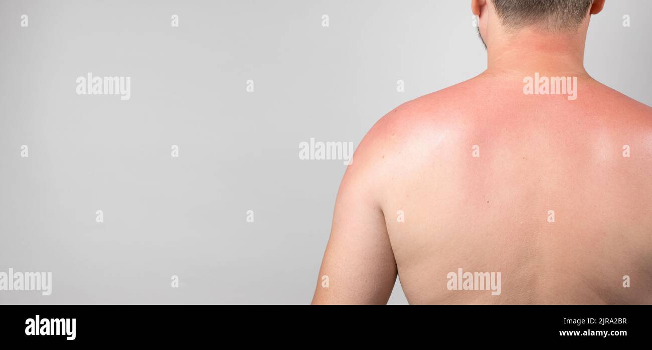 Retro di un uomo con una scottatura solare, primo piano, banner con spazio per il testo in grigio. Foto Stock