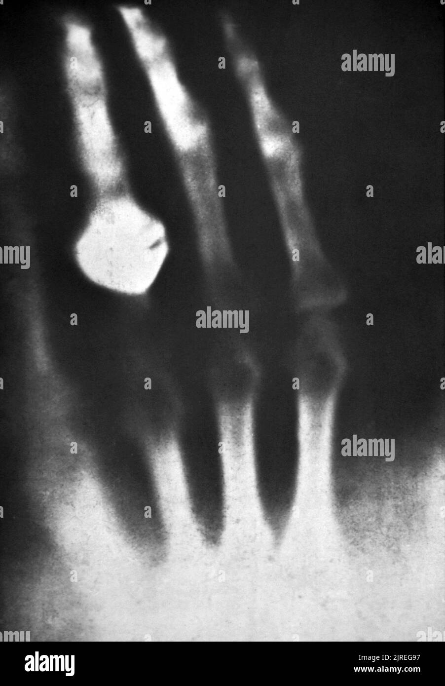 Prima fotografia radiografica di un essere umano (1895). L'immagine fu fatta da Wilhelm Roentgen (1845-1923) poco dopo la sua scoperta di raggi X nel 1895. Mostra la mano di sua moglie, che indossa un anello. Roentgen fu professore di fisica a Wurzburg, Germania. Mentre utilizzava un tubo di scarica elettrica in una stanza buia, notò che una scheda rivestita di platinocianuro di bario si illuminava quando il tubo era acceso. L'effetto non è stato bloccato da una parete interposta, o anche da un sottile foglio di metallo. Roentgen definì questa radiazione a raggi X e utilizzò la radiazione della mano di sua moglie come prova per mostrare ai colleghi. Foto Stock