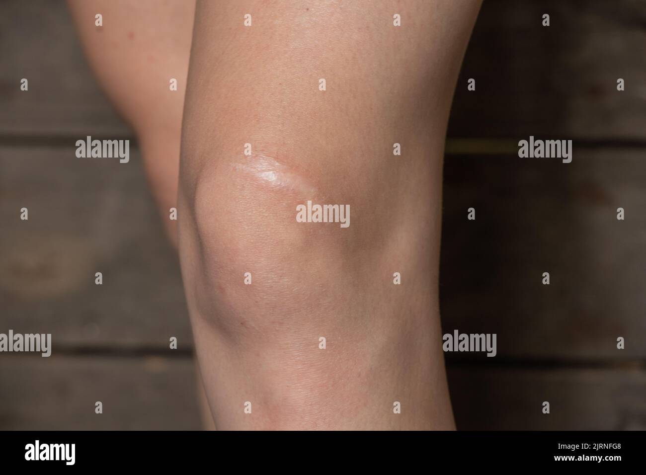 ginocchia di una giovane ragazza bianca con una cicatrice Foto Stock