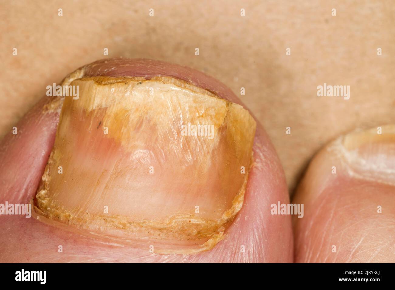 Unghie fungo (onicomicosi) sul piede destro grande Foto Stock